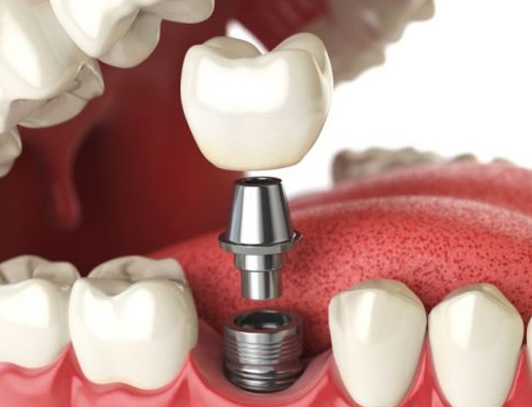 Implante Dentário Odonto Vila Maria